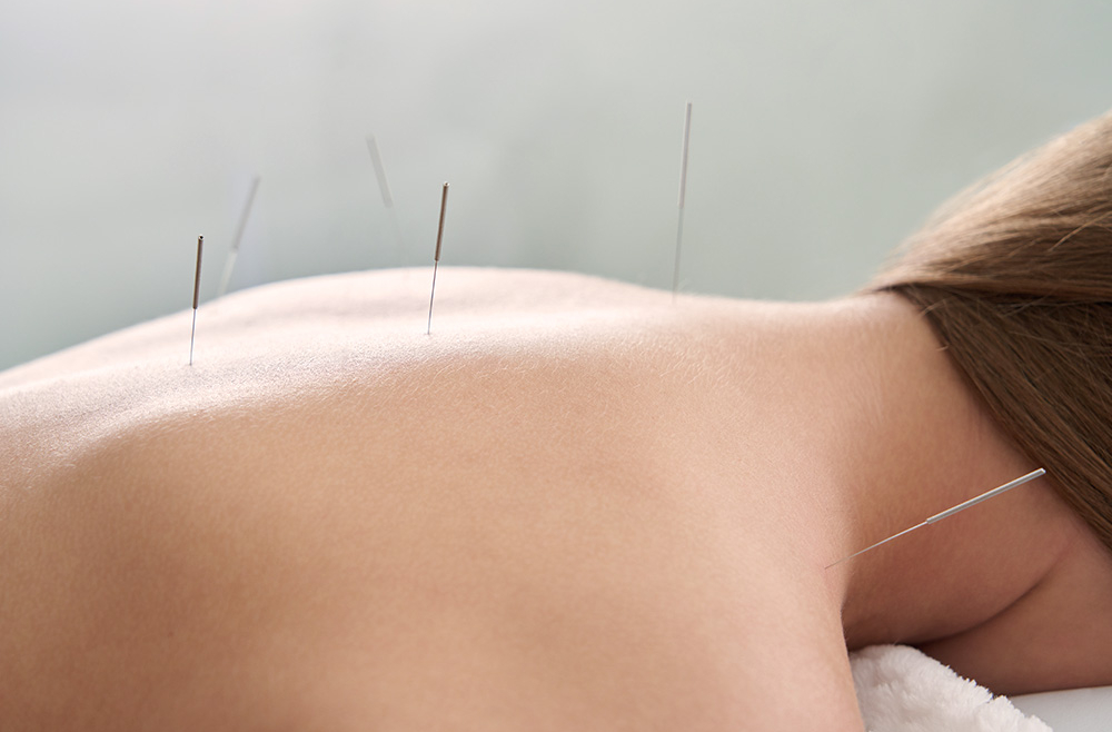 Acupuncture