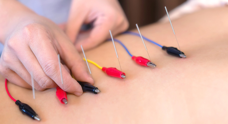 Electroacupuncture - Services - KatieKim Acupuncture & Herb Clinic