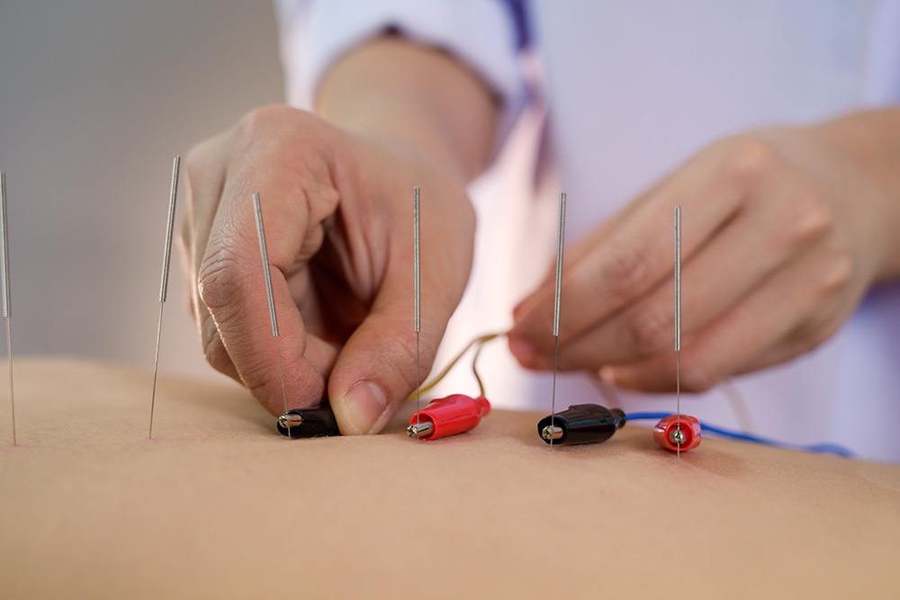 Electrical Stimulation - KatieKim Acupuncture & Herb Clinic